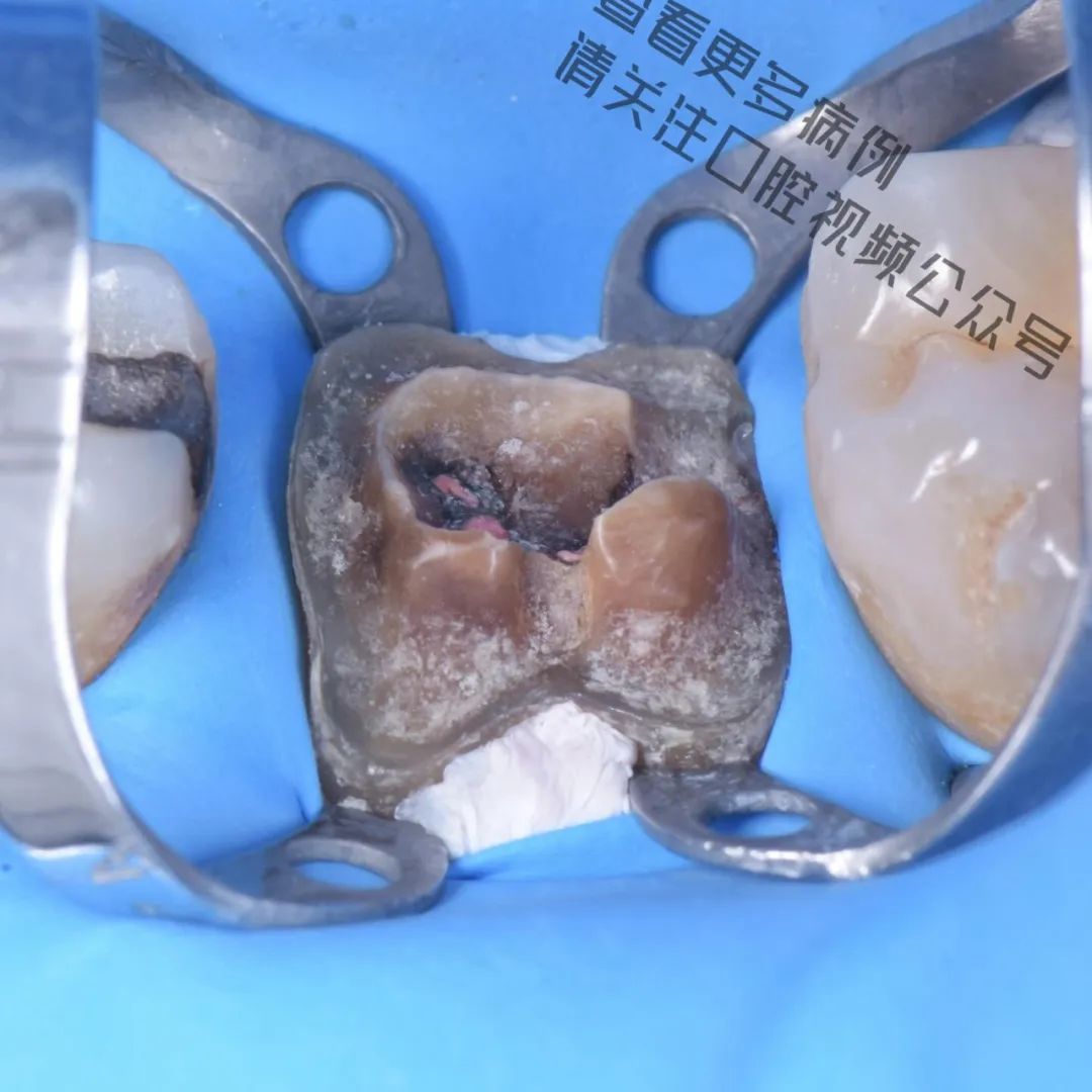 一颗濒临拔除的患牙,仿生学来修复它
