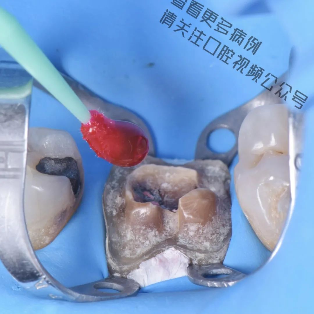 一颗濒临拔除的患牙,仿生学来修复它