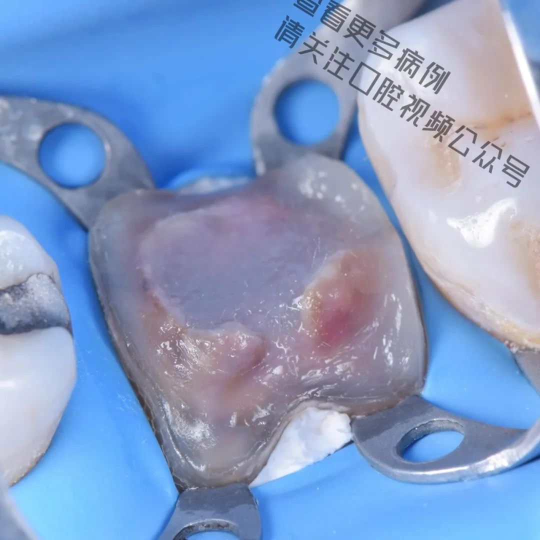 一颗濒临拔除的患牙,仿生学来修复它