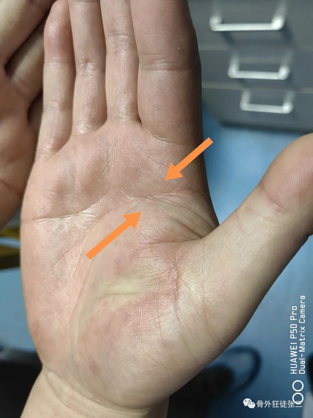 罕见病:掌指关节绞索