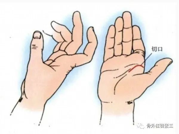 罕见病:掌指关节绞索