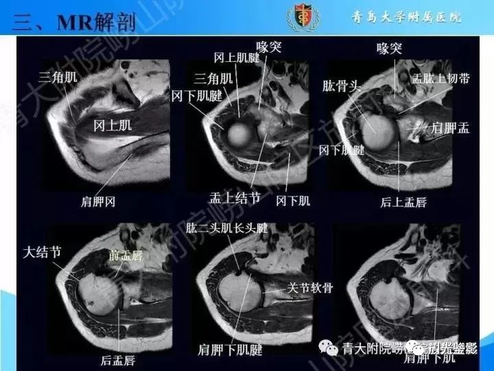 肩关节MRI解剖肩袖损伤诊断技巧--对应动图,效果超赞