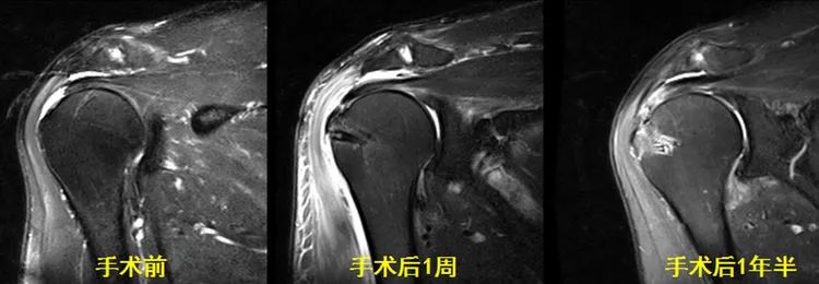 肩关节MRI解剖肩袖损伤诊断技巧--对应动图,效果超赞
