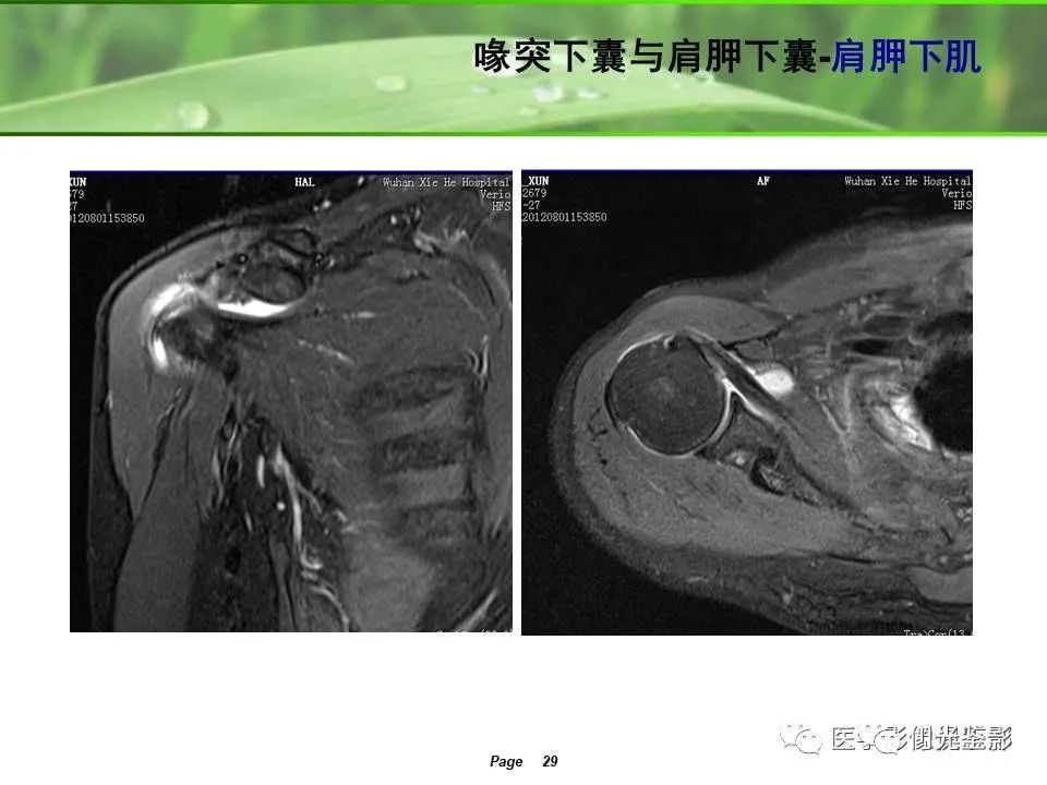 肩关节MRI解剖肩袖损伤诊断技巧--对应动图,效果超赞