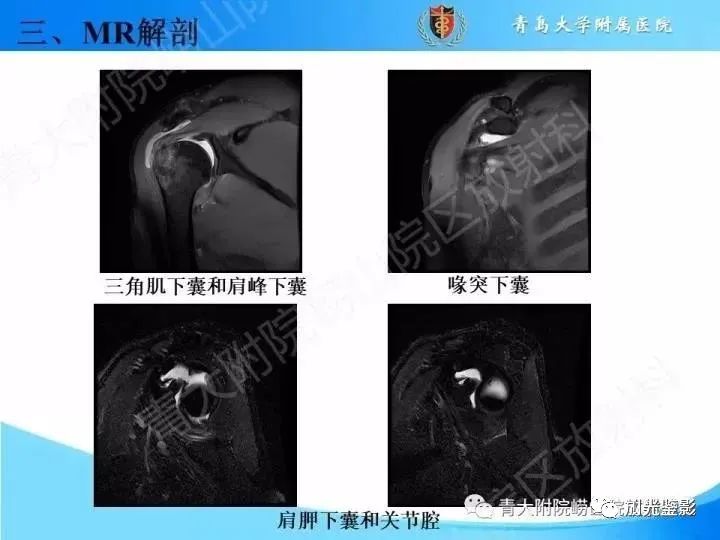 肩关节MRI解剖肩袖损伤诊断技巧--对应动图,效果超赞