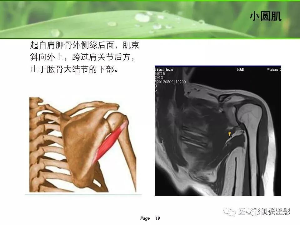 肩关节MRI解剖肩袖损伤诊断技巧--对应动图,效果超赞
