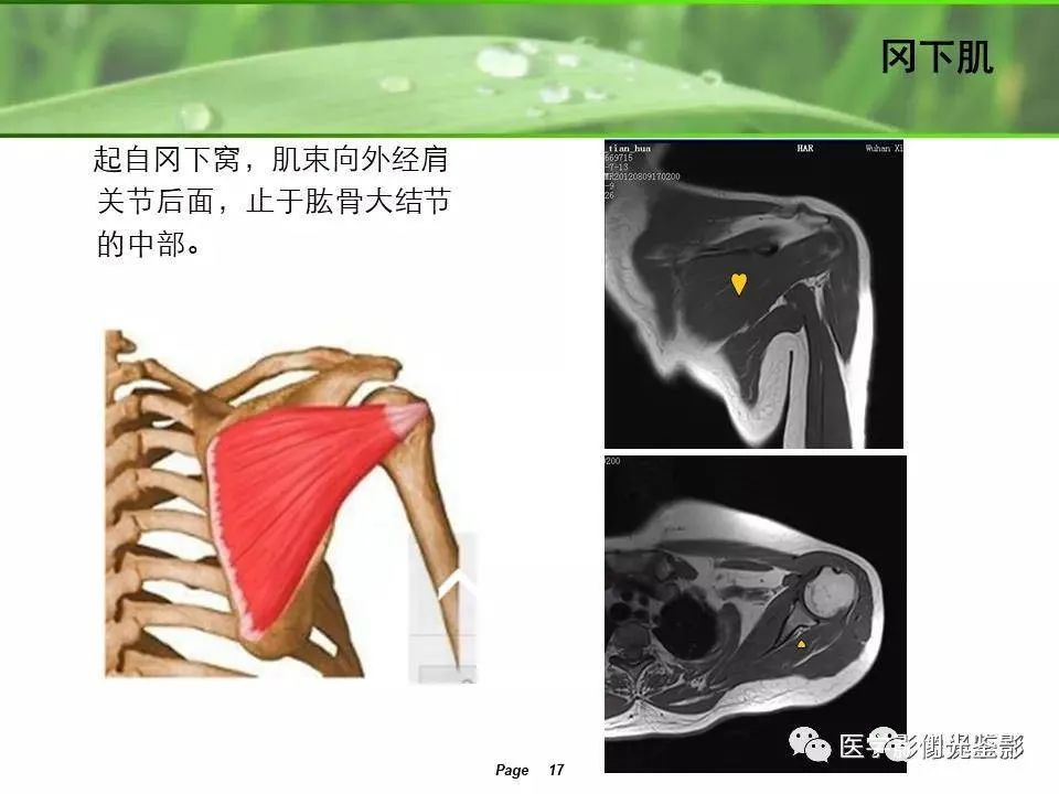 肩关节MRI解剖肩袖损伤诊断技巧--对应动图,效果超赞