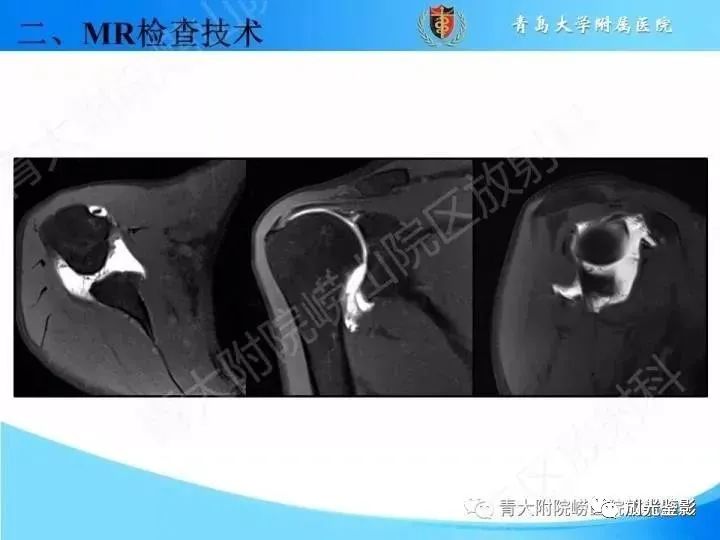 肩关节MRI解剖肩袖损伤诊断技巧--对应动图,效果超赞