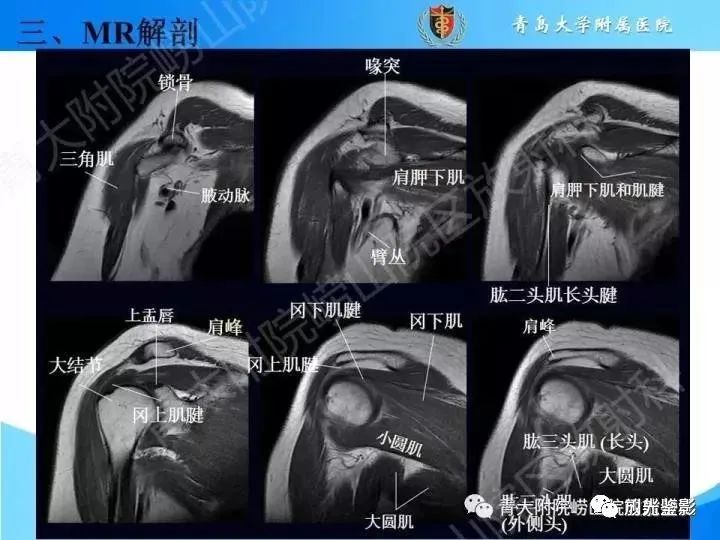 肩关节MRI解剖肩袖损伤诊断技巧--对应动图,效果超赞