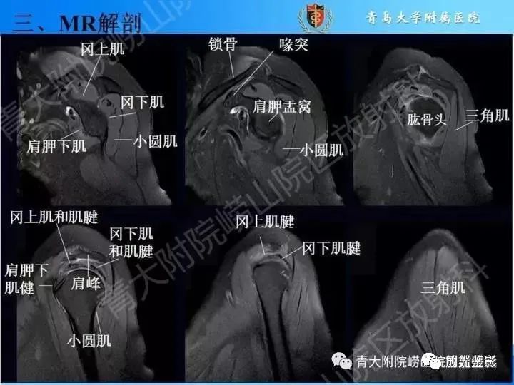 肩关节MRI解剖肩袖损伤诊断技巧--对应动图,效果超赞