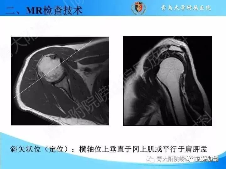 肩关节MRI解剖肩袖损伤诊断技巧--对应动图,效果超赞