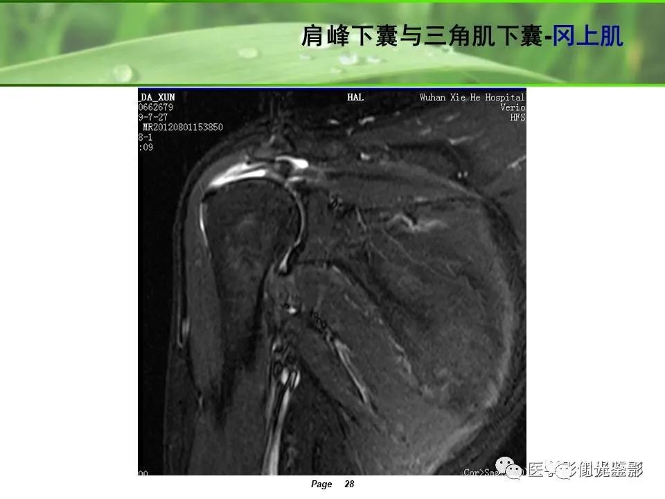肩关节MRI解剖肩袖损伤诊断技巧--对应动图,效果超赞