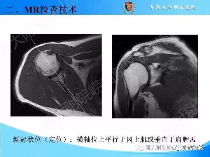 肩关节MRI解剖肩袖损伤诊断技巧--对应动图,效果超赞