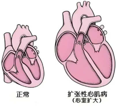 一文读懂!心肌病从诊断到治疗的关键策略