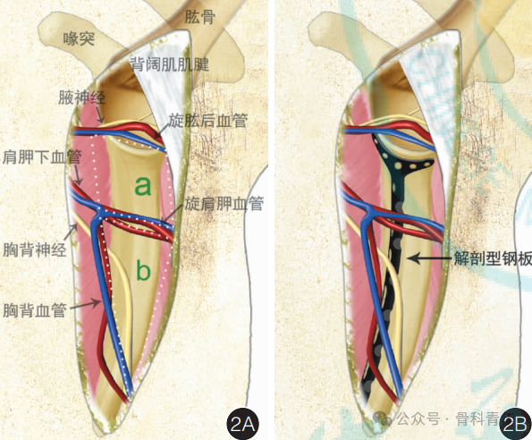 “腋窝入路”显露肩胛盂:解剖与手术技术