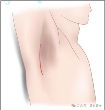 “腋窝入路”显露肩胛盂:解剖与手术技术