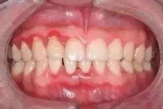 牙龈出现白脓包,该怎么处理