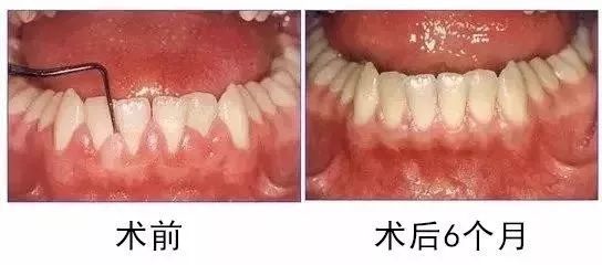 牙龈出现白脓包,该怎么处理