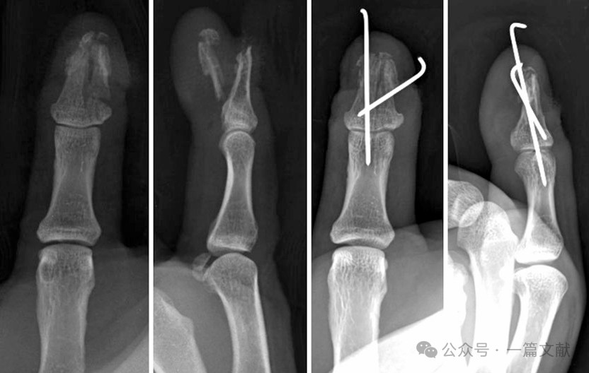拇指骨折的内固定方式汇总