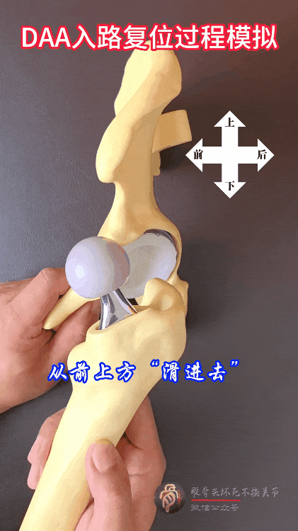 髋臼骨折4块板15颗钉,关节怎么换?