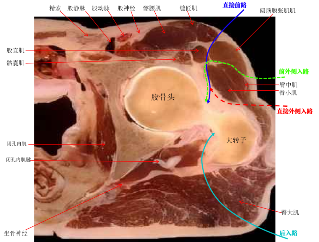髋臼骨折4块板15颗钉,关节怎么换?