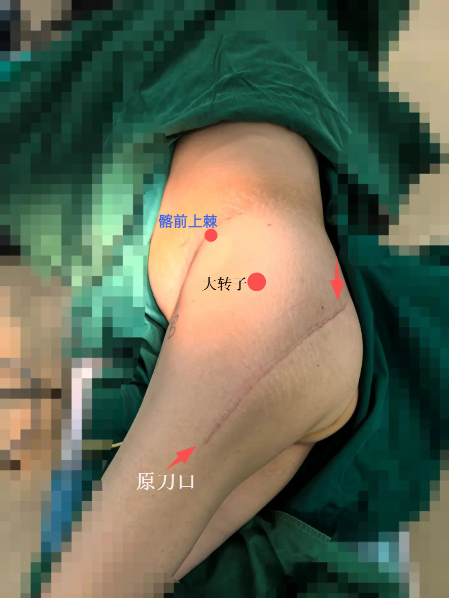 髋臼骨折4块板15颗钉,关节怎么换?