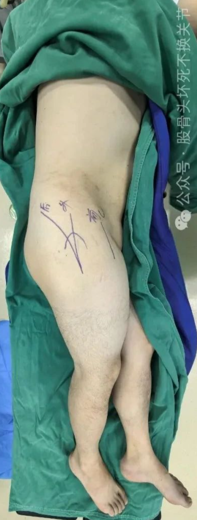 髋臼骨折4块板15颗钉,关节怎么换?