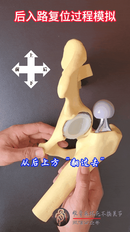 髋臼骨折4块板15颗钉,关节怎么换?
