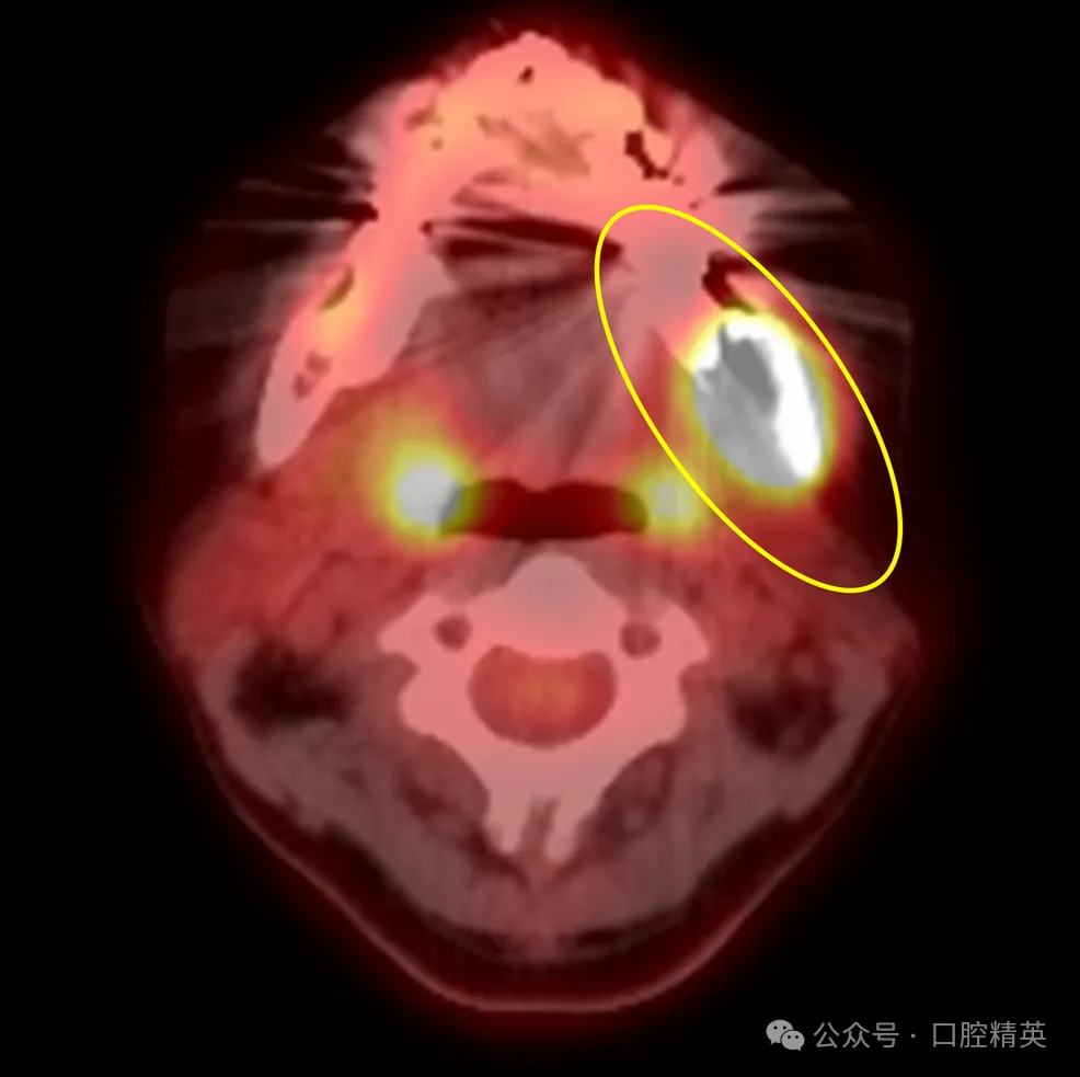 智齿也不要乱拔,可能是骨内癌