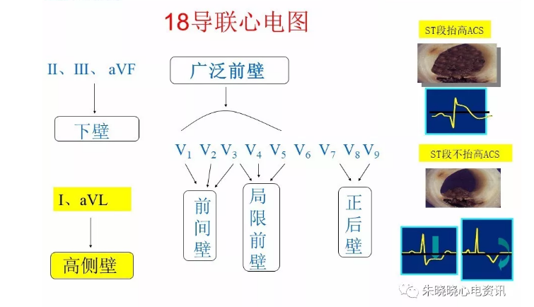 急性冠脉综合征患者的识别与救治