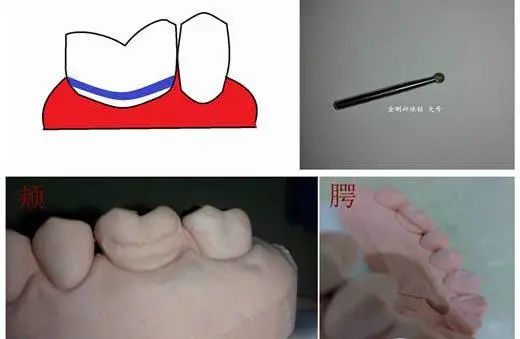 三根车针，六步完成——快速磨牙全冠预备