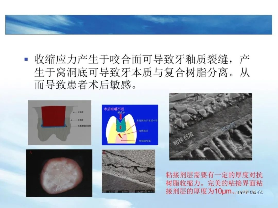 树脂充填后敏感的原因，这几点不可忽略！