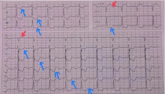 STEMI