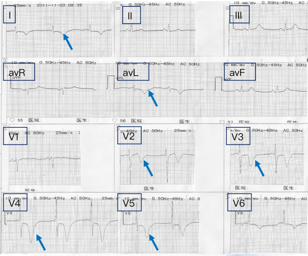 STEMI