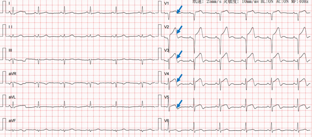 STEMI