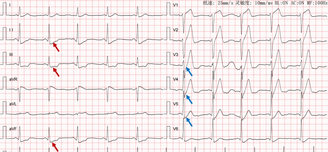 STEMI