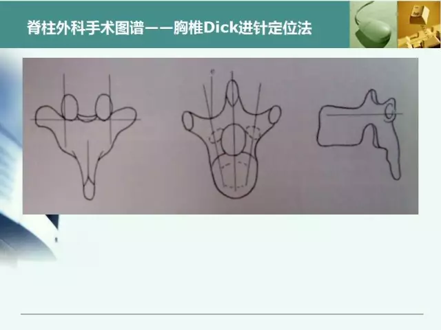 胸腰椎椎弓根置钉技术，很全很实用！
