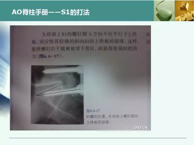 胸腰椎椎弓根置钉技术，很全很实用！
