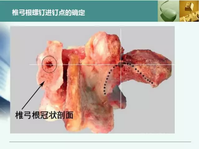 胸腰椎椎弓根置钉技术，很全很实用！