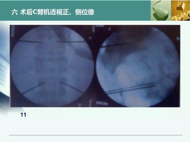 胸腰椎椎弓根置钉技术，很全很实用！