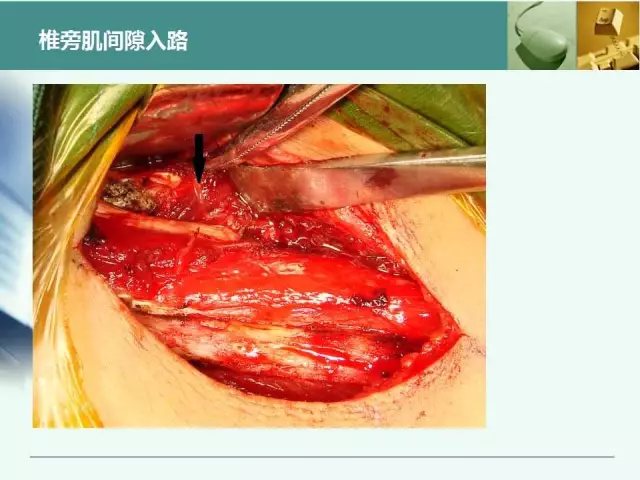 胸腰椎椎弓根置钉技术，很全很实用！