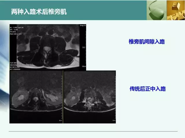胸腰椎椎弓根置钉技术，很全很实用！