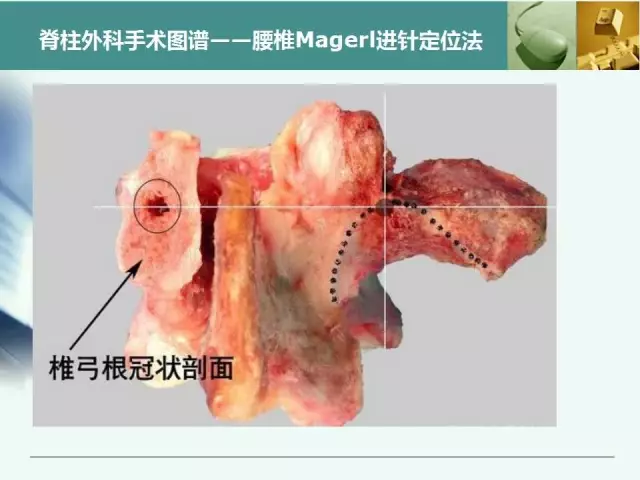 胸腰椎椎弓根置钉技术，很全很实用！