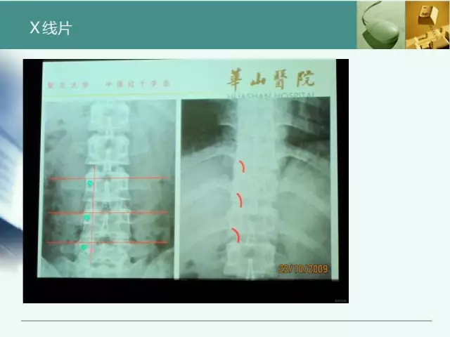 胸腰椎椎弓根置钉技术，很全很实用！