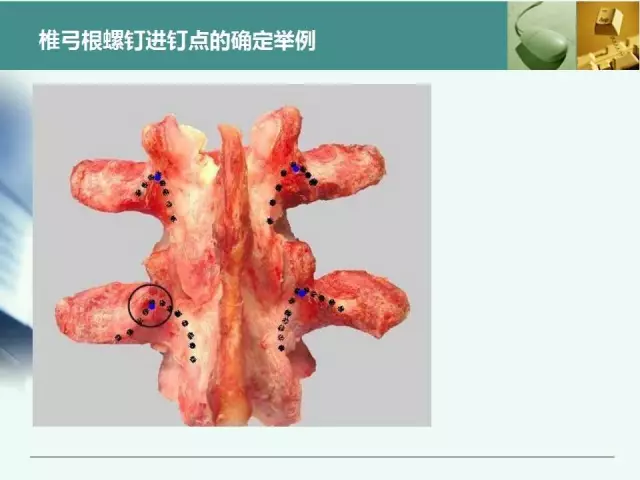 胸腰椎椎弓根置钉技术，很全很实用！