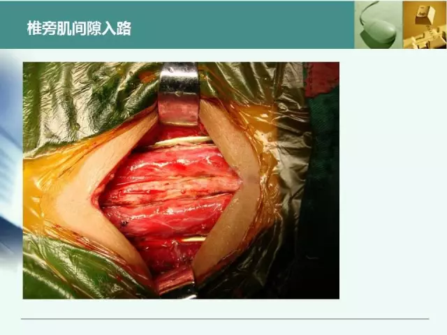 胸腰椎椎弓根置钉技术，很全很实用！