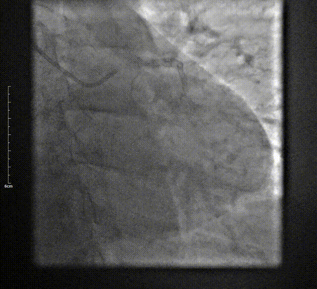 Launcher病例荟 | SAL导管在钙化病变中的应用