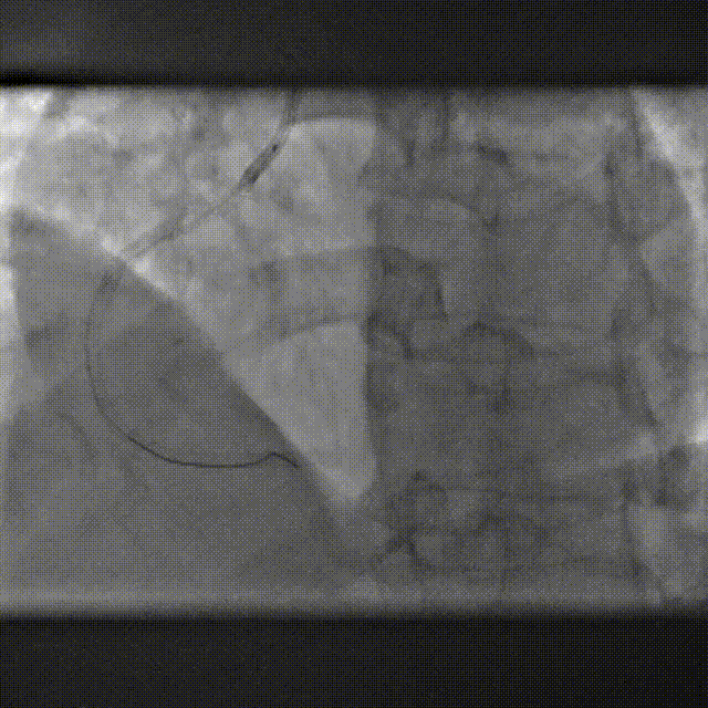 Launcher病例荟 | SAL导管在钙化病变中的应用