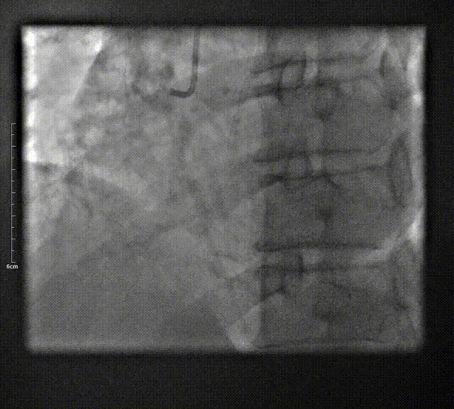 Launcher病例荟 | SAL导管在钙化病变中的应用