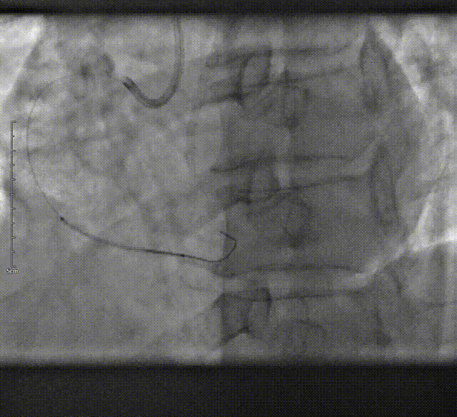 Launcher病例荟 | SAL导管在钙化病变中的应用
